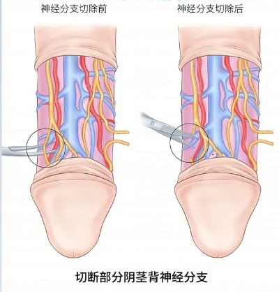 背神经阻断术做后多久有效果 背神经阻断手术后能不能修复神经了